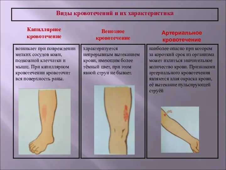 Капиллярное кровотечение Венозное кровотечение Артериальное кровотечение