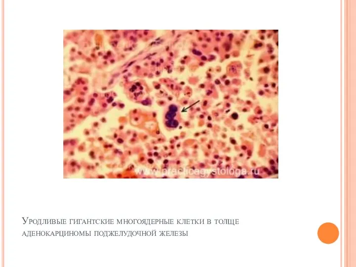 Уродливые гигантские многоядерные клетки в толще аденокарциномы поджелудочной железы