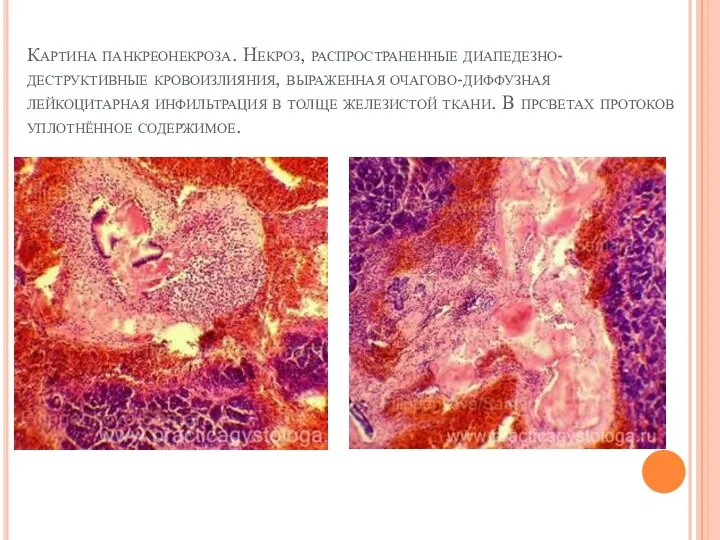Картина панкреонекроза. Некроз, распространенные диапедезно-деструктивные кровоизлияния, выраженная очагово-диффузная лейкоцитарная инфильтрация