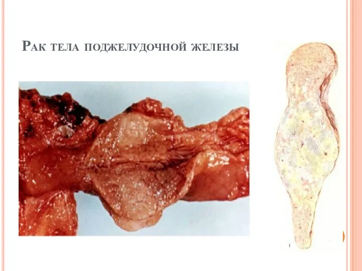 Рак тела поджелудочной железы
