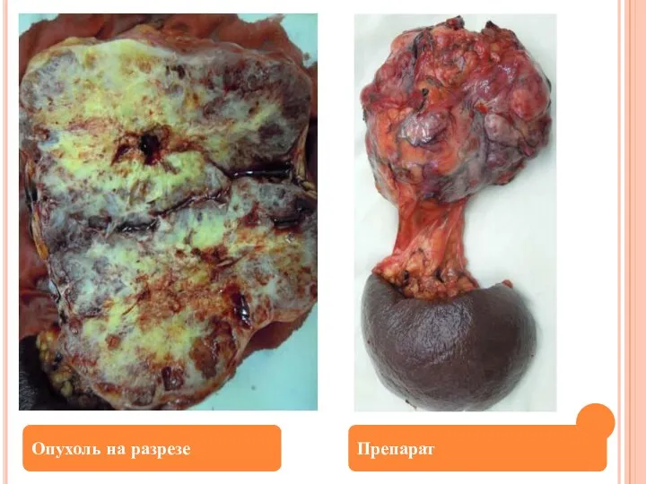 Опухоль на разрезе Препарат