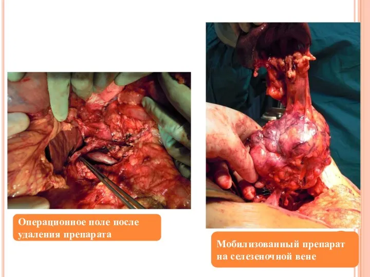 Операционное поле после удаления препарата Мобилизованный препарат на селезеночной вене