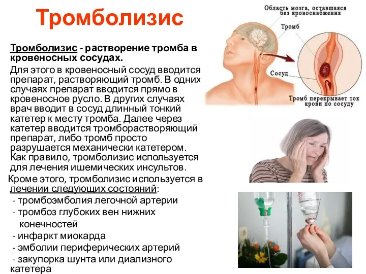 Тромболизис Тромболизис - растворение тромба в кровеносных сосудах. Для этого