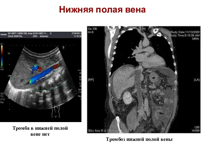 Нижняя полая вена Тромбоз нижней полой вены Тромба в нижней полой вене нет