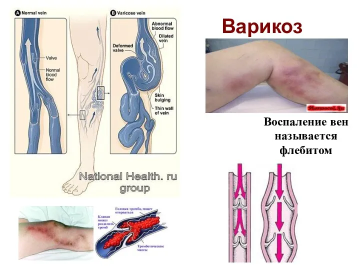 Варикоз Воспаление вен называется флебитом