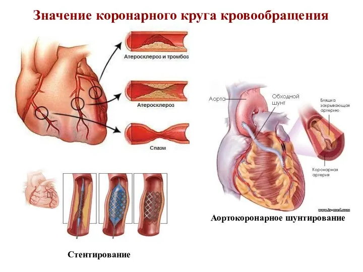 Стентирование Аортокоронарное шунтирование Значение коронарного круга кровообращения