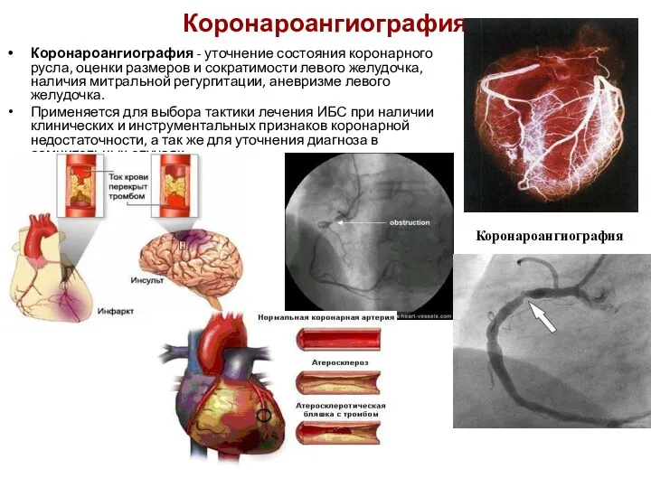 Коронароангиография Коронароангиография - уточнение состояния коронарного русла, оценки размеров и