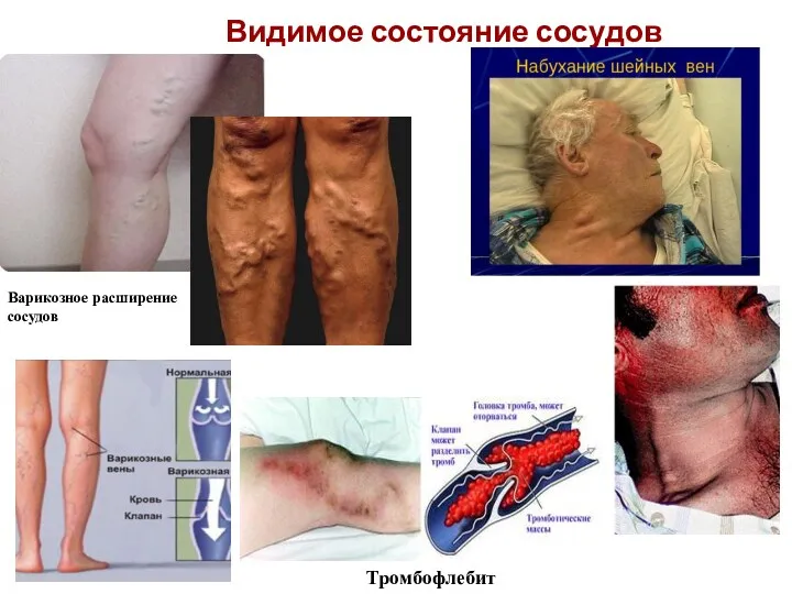 Видимое состояние сосудов Тромбофлебит Варикозное расширение сосудов