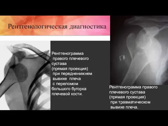 Рентгенограмма правого плечевого сустава (прямая проекция) при передненижнем вывихе плеча с переломом большого