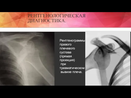 РЕНТГЕНОЛОГИЧЕСКАЯ ДИАГНОСТИКА. Рентгенограммы правого плечевого сустава (прямая проекция) при травматическом вывихе плеча.