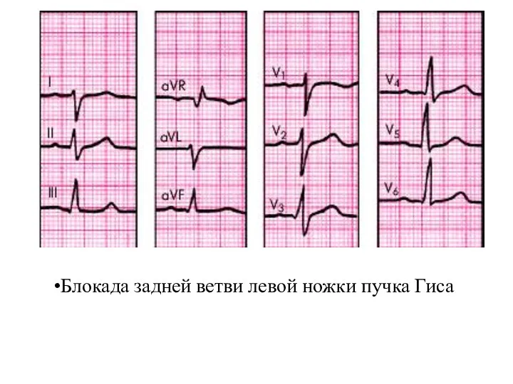 Блокада задней ветви левой ножки пучка Гиса