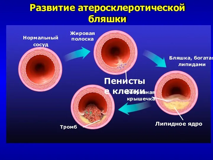 Нормальный сосуд Жировая полоска Пенистые клетки Бляшка, богатая липидами Липидное