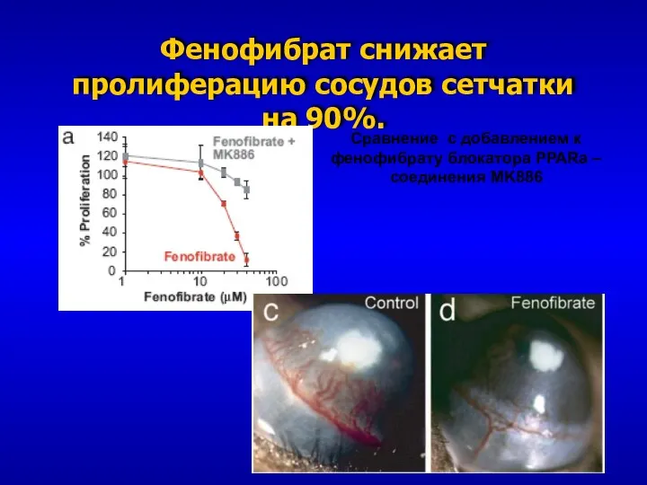 Фенофибрат снижает пролиферацию сосудов сетчатки на 90%.