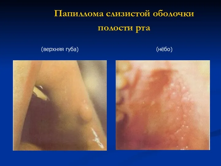 Папиллома слизистой оболочки полости рта (нёбо) (верхняя губа)