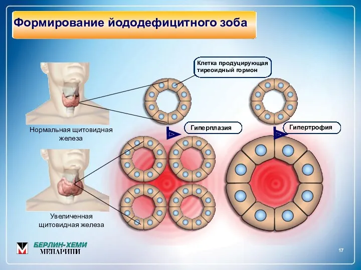 17 Формирование йододефицитного зоба Нормальная щитовидная железа Увеличенная щитовидная железа Гиперплазия Гипертрофия Клетка продуцирующая тиреоидный гормон