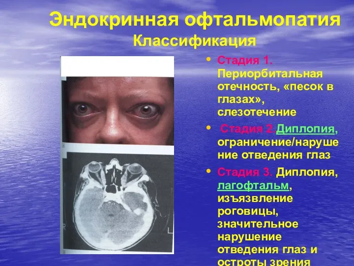 Эндокринная офтальмопатия Классификация Стадия 1. Периорбитальная отечность, «песок в глазах»,