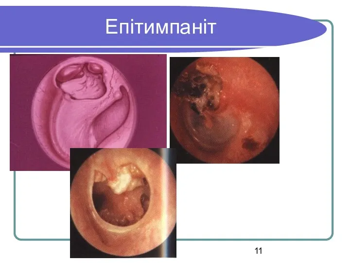 Епітимпаніт