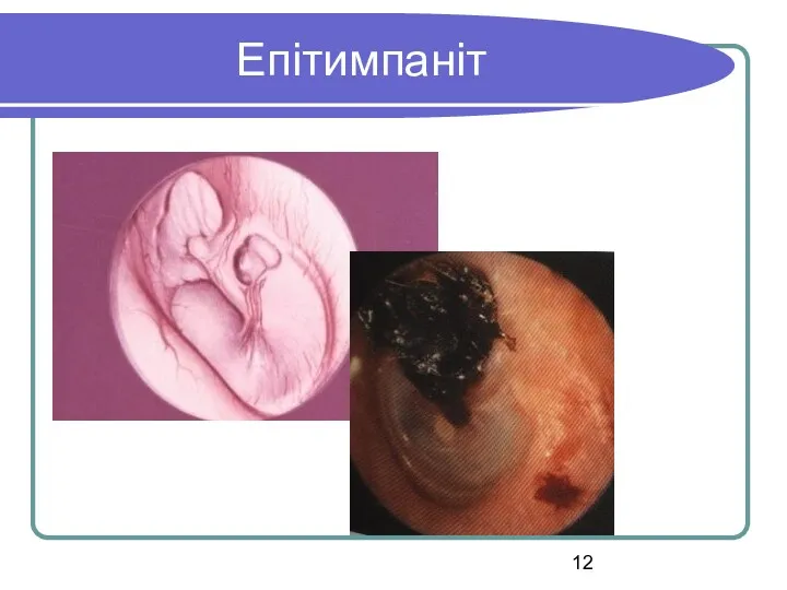 Епітимпаніт