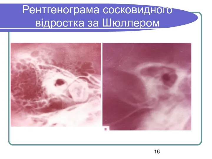 Рентгенограма сосковидного відростка за Шюллером