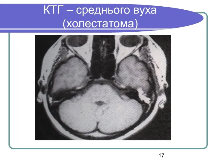 КТГ – среднього вуха (холестатома)