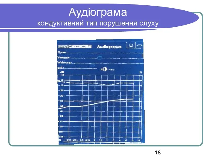 Аудіограма кондуктивний тип порушення слуху