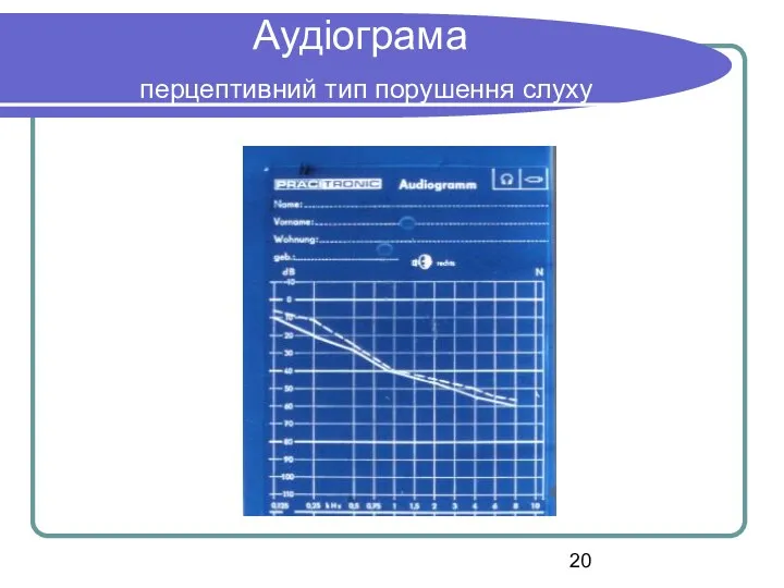 Аудіограма перцептивний тип порушення слуху