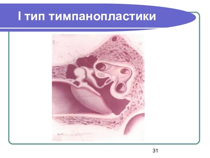 І тип тимпанопластики