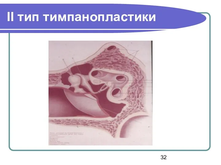 ІІ тип тимпанопластики