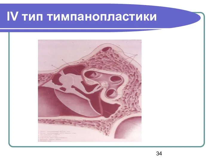 ІV тип тимпанопластики