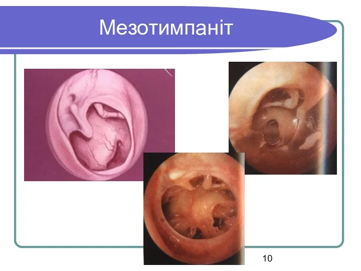 Мезотимпаніт