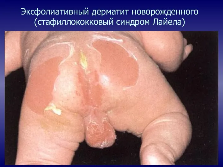 Эксфолиативный дерматит новорожденного (стафиллококковый синдром Лайела)