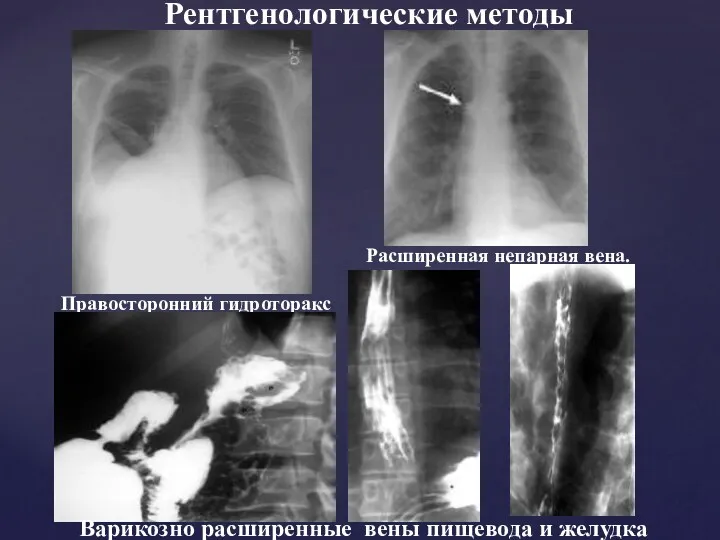 Правосторонний гидроторакс Расширенная непарная вена. Рентгенологические методы Варикозно расширенные вены пищевода и желудка