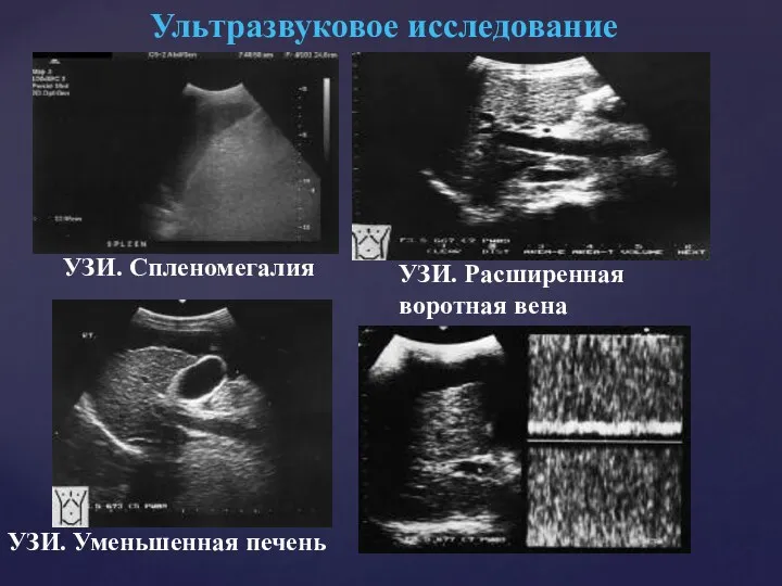 Ультразвуковое исследование УЗИ. Спленомегалия УЗИ. Расширенная воротная вена УЗИ. Уменьшенная печень