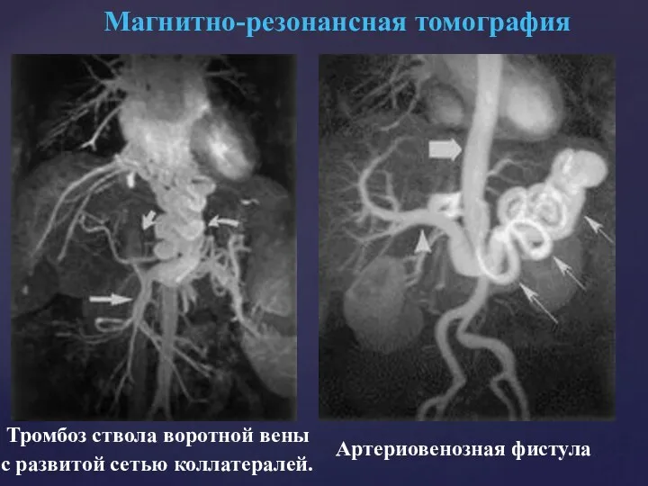 Тромбоз ствола воротной вены с развитой сетью коллатералей. Магнитно-резонансная томография Артериовенозная фистула