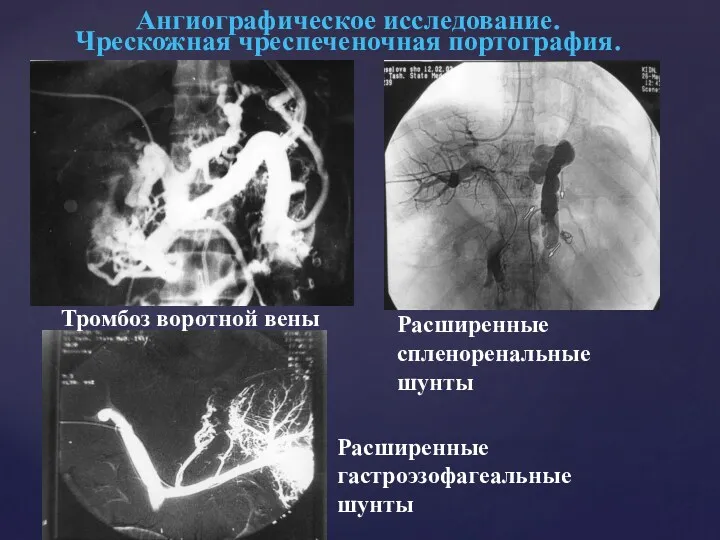 Ангиографическое исследование. Чрескожная чреспеченочная портография. Тромбоз воротной вены Расширенные гастроэзофагеальные шунты Расширенные спленоренальные шунты