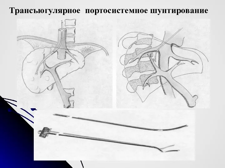 Трансъюгулярное портосистемное шунтирование