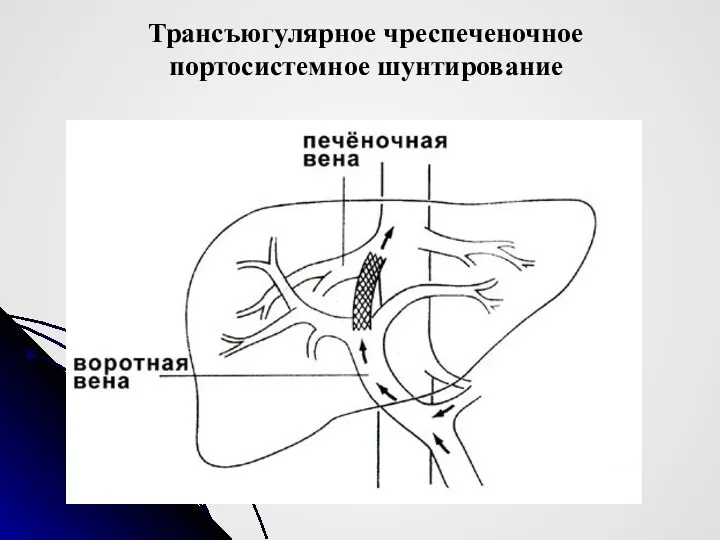 Трансъюгулярное чреспеченочное портосистемное шунтирование