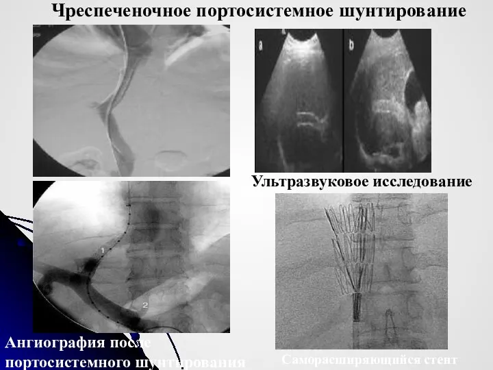 Ангиография после портосистемного шунтирования Ультразвуковое исследование Чреспеченочное портосистемное шунтирование Саморасширяющийся стент