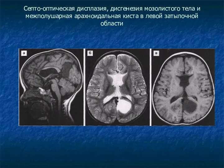 Септо-оптическая дисплазия, дисгенезия мозолистого тела и межполушарная арахноидальная киста в левой затылочной области