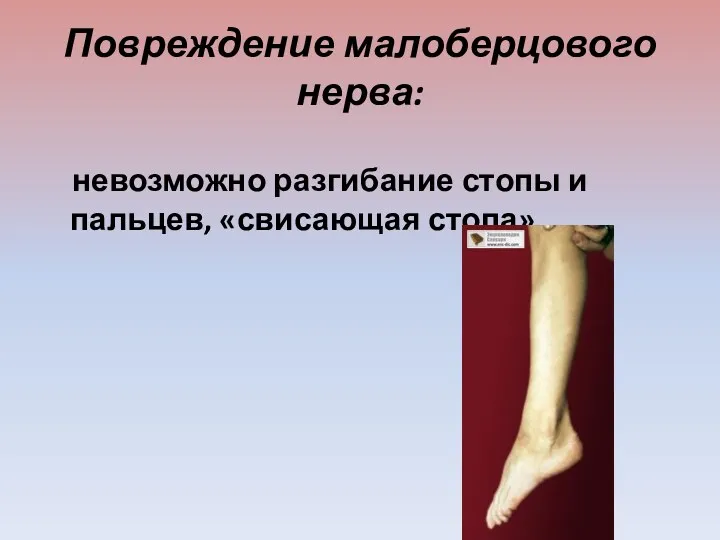Повреждение малоберцового нерва: невозможно разгибание стопы и пальцев, «свисающая стопа»