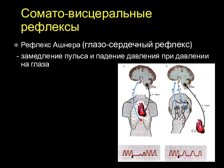 Сомато-висцеральные рефлексы Рефлекс Ашнера (глазо-сердечный рефлекс) замедление пульса и падение давления при давлении на глаза