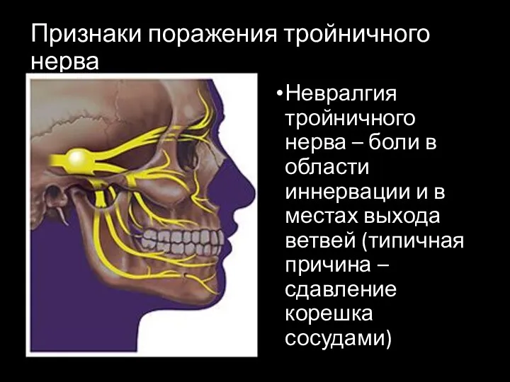 Признаки поражения тройничного нерва Невралгия тройничного нерва – боли в области иннервации и