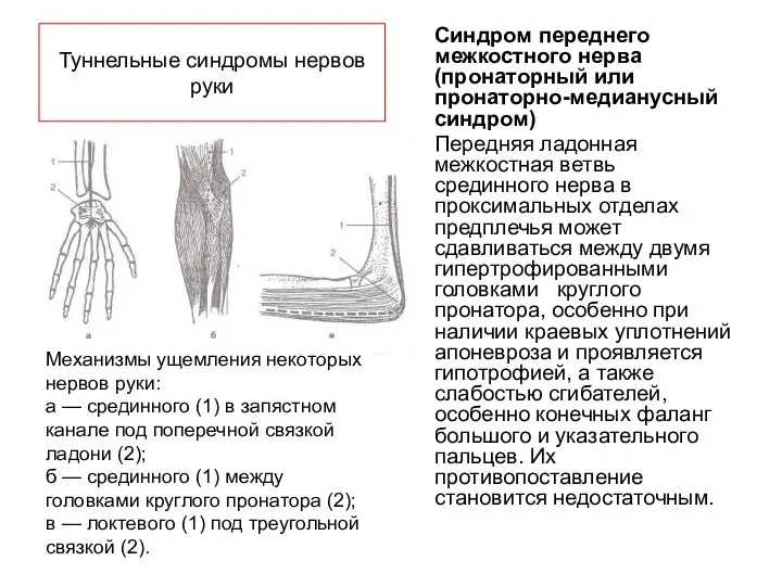 Туннельные синдромы нервов руки Синдром переднего межкостного нерва (пронаторный или пронаторно-медианусный синдром) Передняя