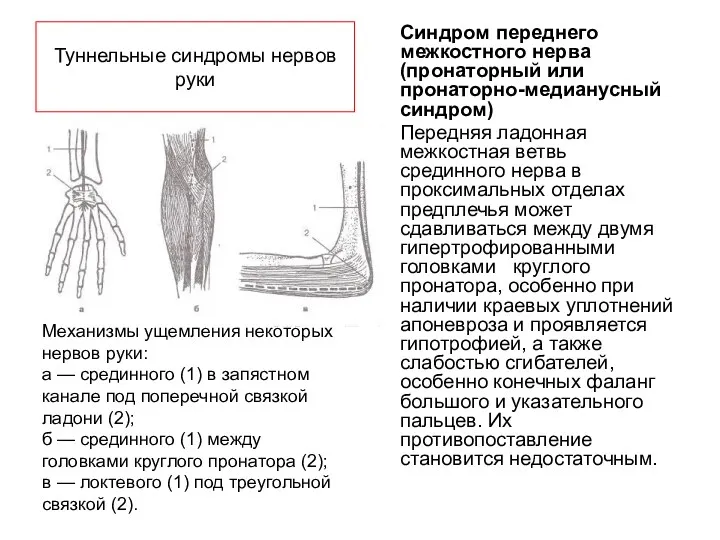 Туннельные синдромы нервов руки Синдром переднего межкостного нерва (пронаторный или