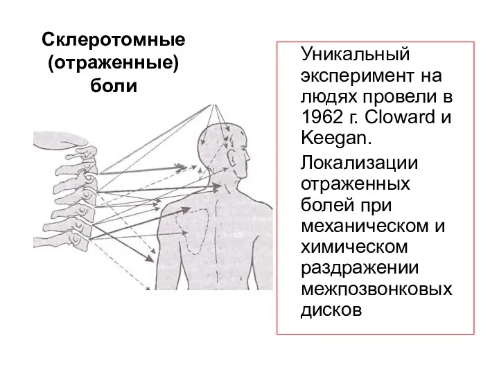 Склеротомные (отраженные) боли Уникальный эксперимент на людях провели в 1962 г. Cloward и