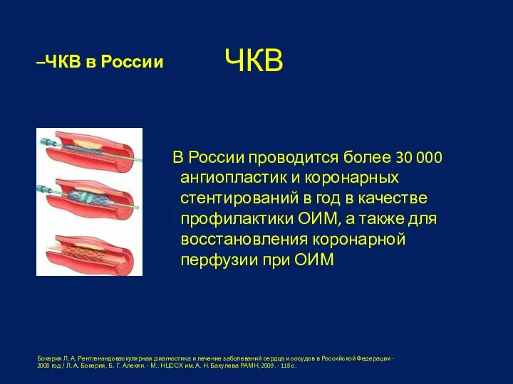 В России проводится более 30 000 ангиопластик и коронарных стентирований