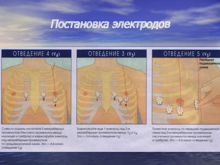 Постановка электродов