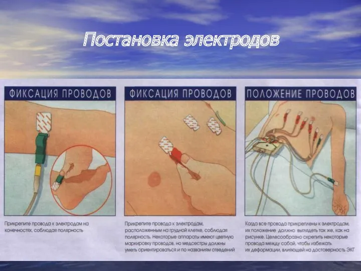 Постановка электродов