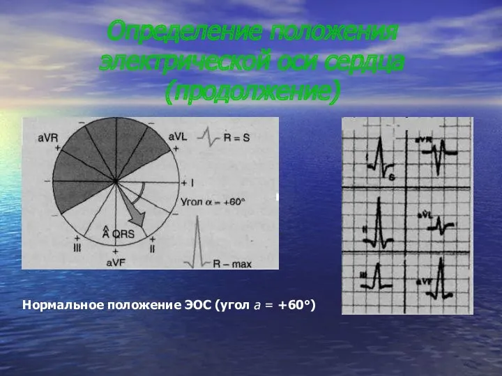 Определение положения электрической оси сердца(продолжение) Нормальное положение ЭОС (угол а = +60°)