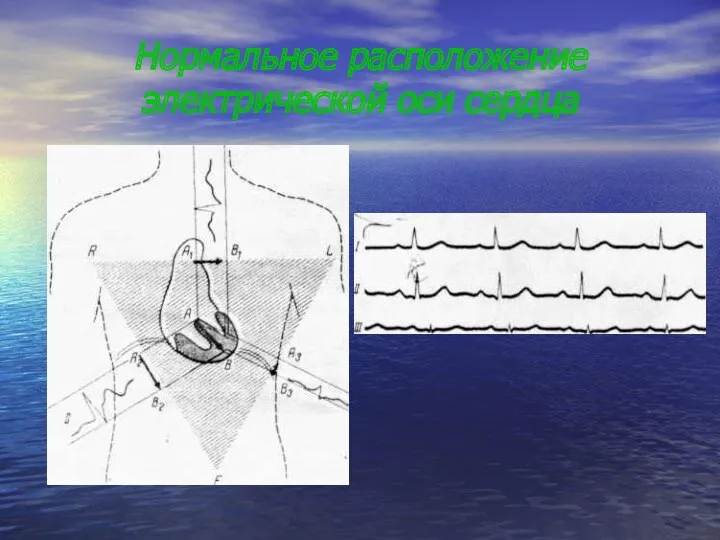 Нормальное расположение электрической оси сердца